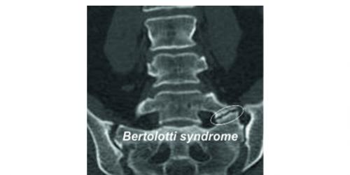 Bertolotti Syndrome